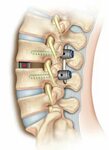 Spondylolysis and Spondylolisthesis part 2. - Neuro Infiny